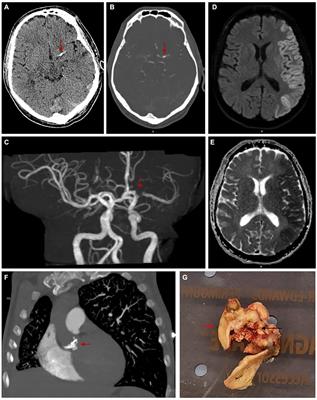 Spontaneous calcified cerebral emboli: a comprehensive review and proposed diagnostic criteria